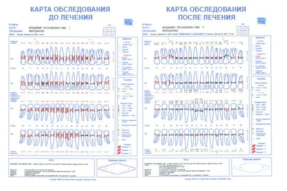 Як же працює система «Florida Probe»?